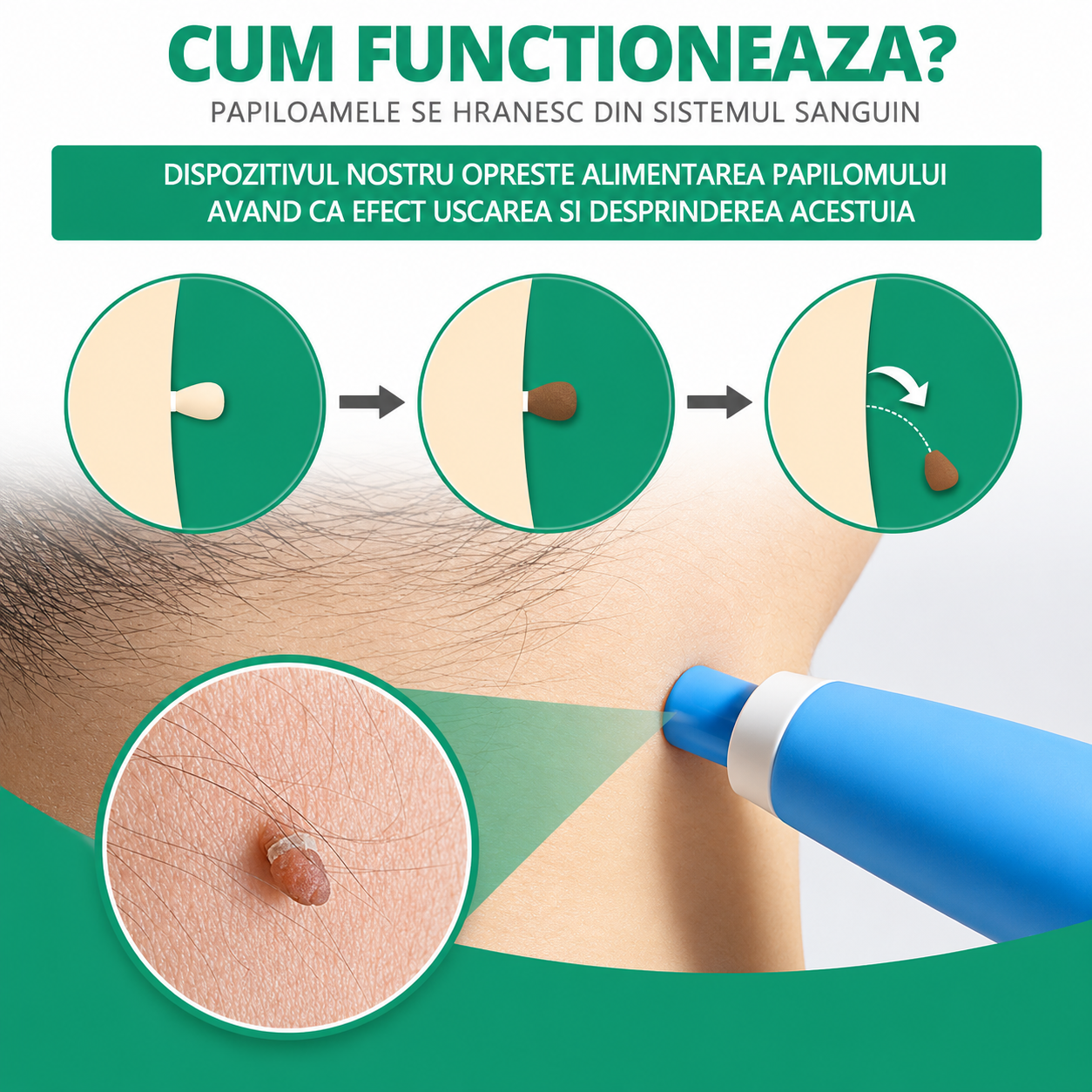 Kit Eliminator de Papiloame şi Imperfecțiuni ale pielii